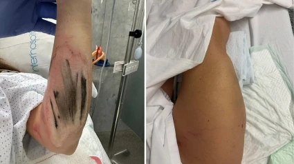 Heridas sufridas por I.G. en el atropello